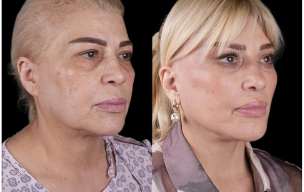 Mətanət İsgəndərli əməliyyatdan ƏVVƏL VƏ SONRA