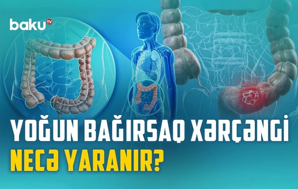 Yoğun bağırsaq xərçənginin qarşısını necə almaq olar?