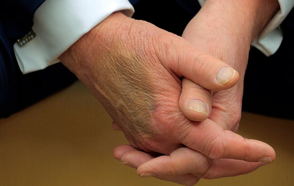A strange bruise was noticed again on Trump's hand
