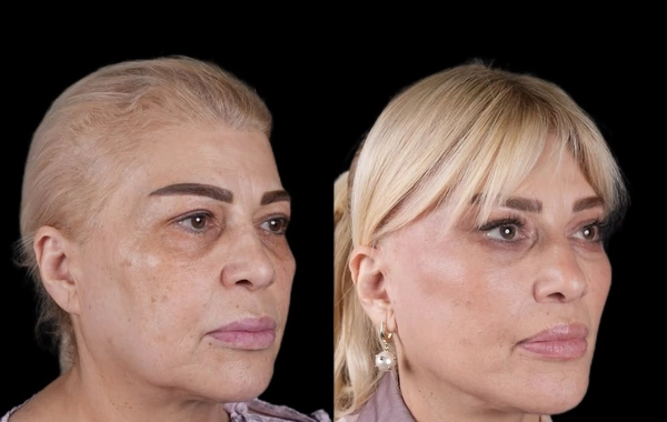 Mətanət İsgəndərli əməliyyatdan ƏVVƏL VƏ SONRA