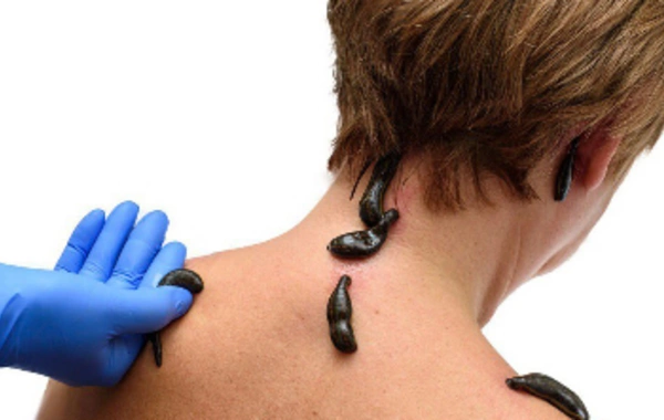 Leech therapy: why the procedure has no place in the 21st century?