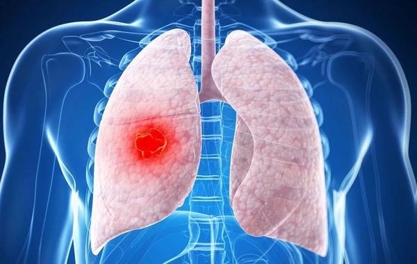 В Минздраве Азербайджана назвали причины роста случаев пневмонии