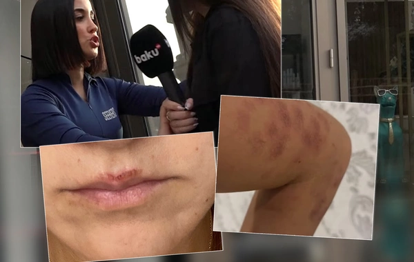 Bakıda salonda qadını lazer edərkən yandırdılar - İDDİA