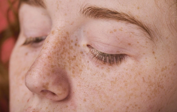 Doctor explained when freckles are a warning sign, not just a skin feature