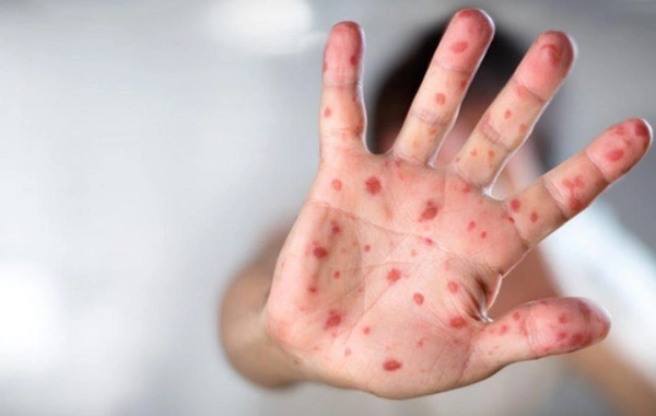 Hazırda Azərbaycanda qızılca və suçiçəyi ilə bağlı epidemioloji vəziyyət sabitdir - RƏSMİ