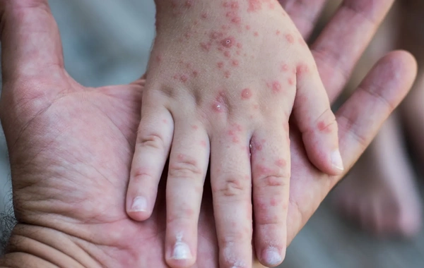 Вирус Коксаки: почему растёт число заражений по всему миру