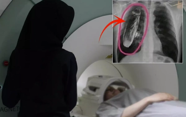 Xəstəyə döş qəfəsində canlı həşərat var deyildi, amma…