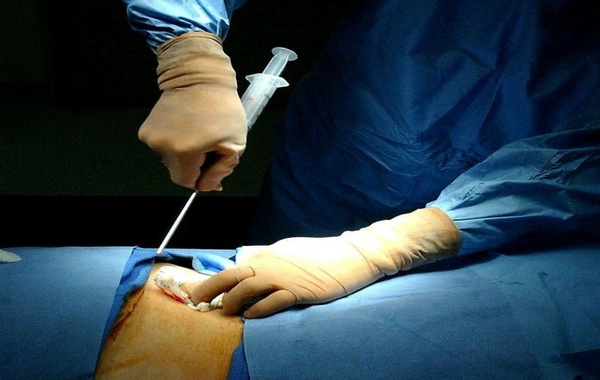 Sümük iliyinin transplantasiyasının limiti artırılıb