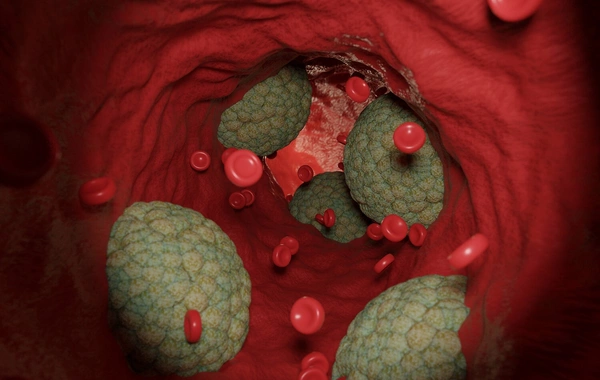 Vaxtından əvvəl ölümlə nəticələnə biləcək gözlənilməz risk faktoru aşkarl