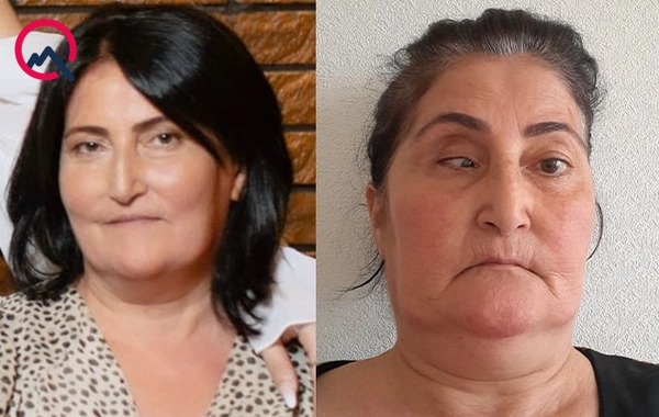 54 yaşlı qadının burnun düzəldəndə gözünü zədələdilər
