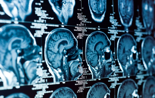 Найден неожиданный провокатор деменции в мозге