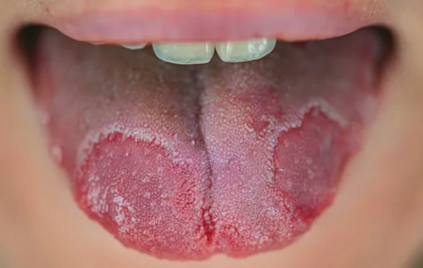 Dil üzərindəki ləkələr bu XƏSTƏLİYİN ƏLAMƏTİDİR