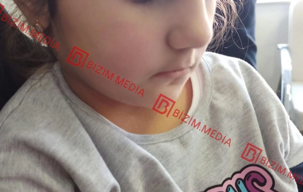 Lənkəranda qandonduran HADİSƏ – Ana isti qaşıqla 3 yaşlı qızının qolunu DAĞLADI