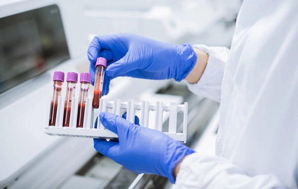 Ученые выяснили, у каких людей риск рака крови снижен на треть