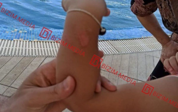 Lənkəranda qandonduran HADİSƏ – Ana isti qaşıqla 3 yaşlı qızının qolunu DAĞLADI