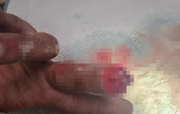 Barmağı qopan şəxs onu buzda saxlayaraq Türkiyəyə çatdırdı