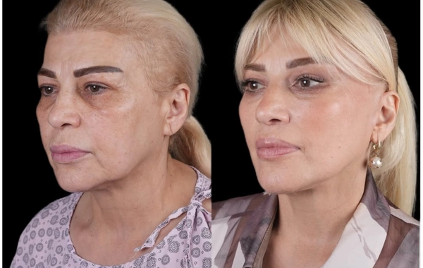 Mətanət İsgəndərli əməliyyatdan ƏVVƏL VƏ SONRA