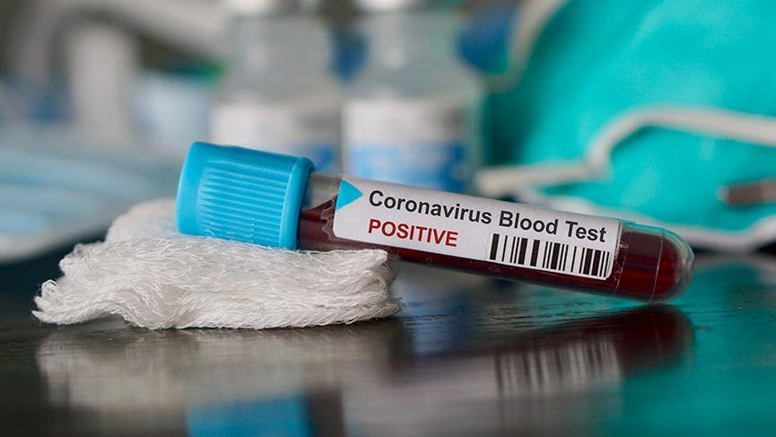 Azərbaycanda daha 78 nəfər koronavirusa yoluxub
