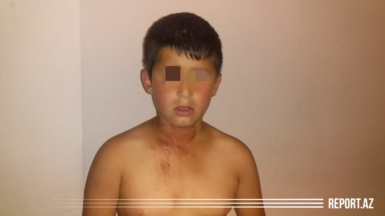 Bakıda DƏHŞƏT - Ata dilənmək istəməyən 11 yaşlı oğlunu başından bıçaqladı - FOTO